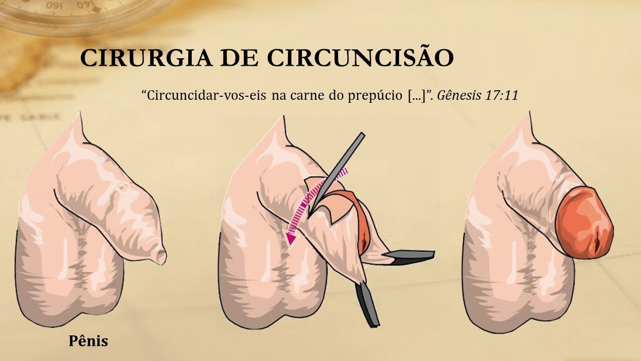 O que é circuncisão?